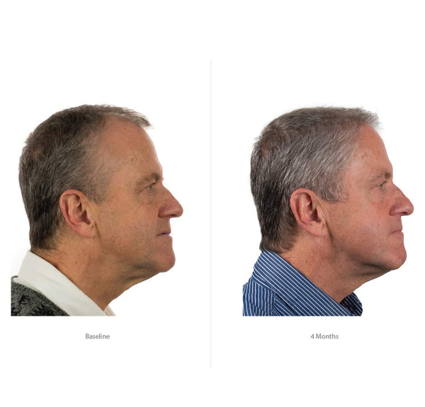 FOLIGAIN Champú avanzado para el crecimiento del cabello Minoxidil 2%