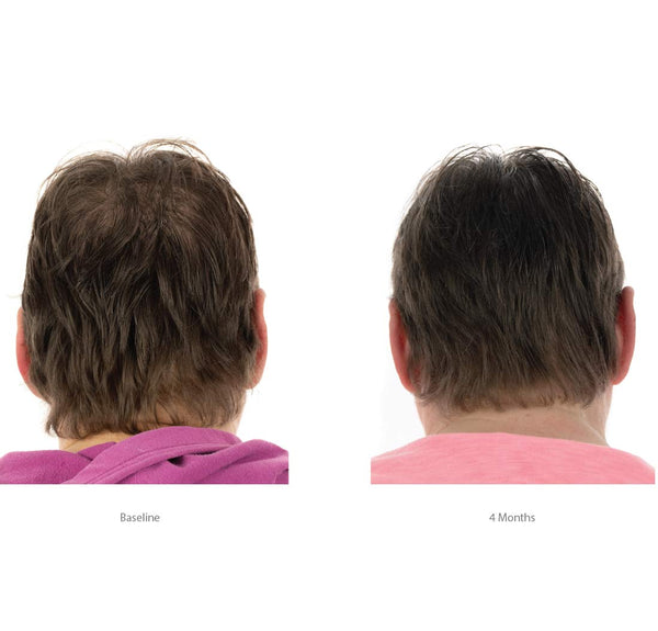 FOLIGAIN Champú avanzado para el crecimiento del cabello Minoxidil 2%